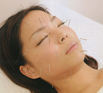 美容鍼(美顔鍼)