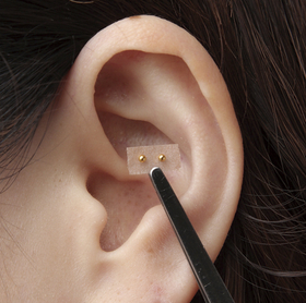 耳鍼(耳つぼダイエット)